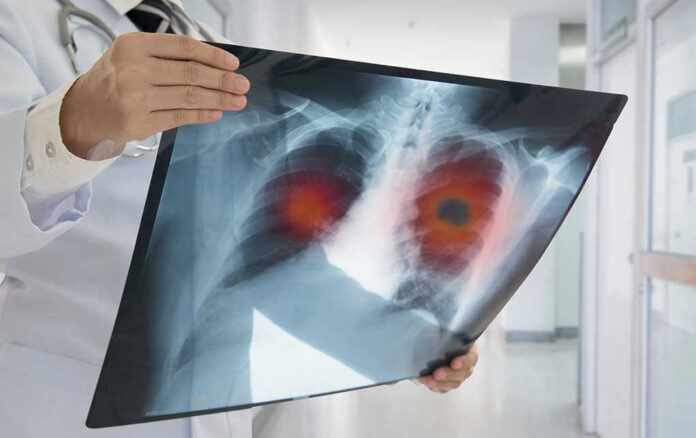 Doctor holding lung X-ray with highlighted areas.